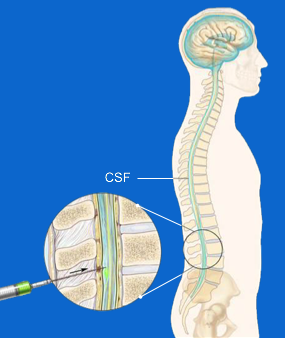 studio terapeutico malattia di Huntington precision hd LIRH